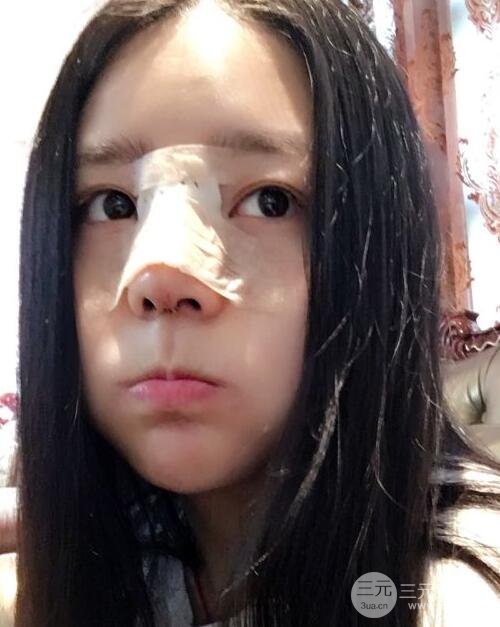 隆鼻整形包括假體隆鼻+耳軟骨墊鼻尖+鼻小柱延長