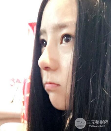 隆鼻整形包括假體隆鼻+耳軟骨墊鼻尖+鼻小柱延長