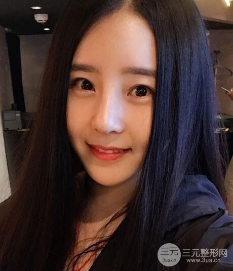 隆鼻整形包括假體隆鼻+耳軟骨墊鼻尖+鼻小柱延長