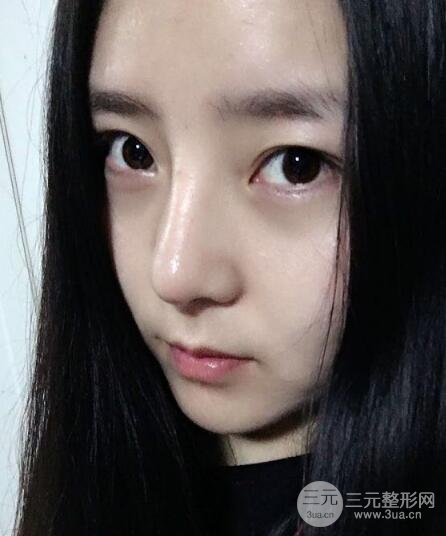 隆鼻整形包括假體隆鼻+耳軟骨墊鼻尖+鼻小柱延長