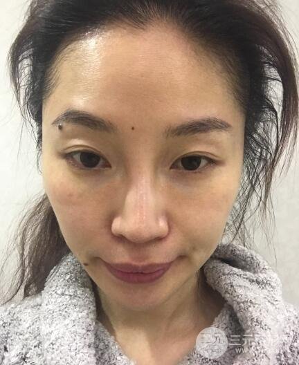 面b提升術(shù)多少錢?價(jià)格和案例分享