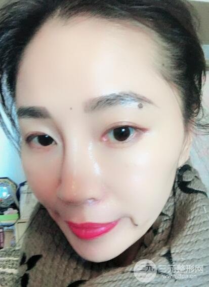 面b提升術(shù)多少錢?價(jià)格和案例分享