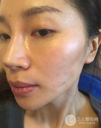 面b提升術(shù)多少錢?價(jià)格和案例分享