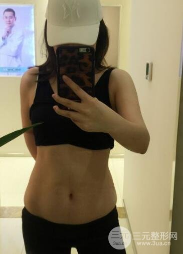 腹部抽脂價(jià)格和恢復(fù)案例