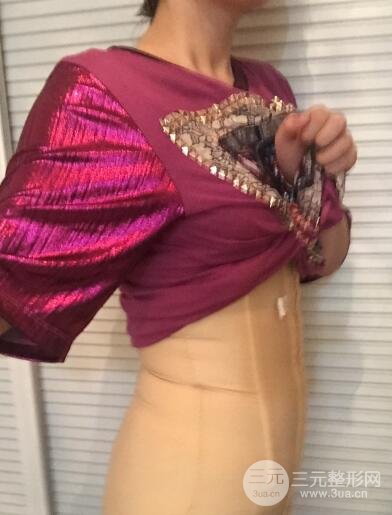 腹部抽脂價(jià)格和恢復(fù)案例