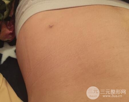 腹部抽脂價(jià)格和恢復(fù)案例