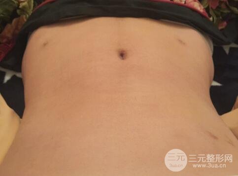 腹部抽脂價(jià)格和恢復(fù)案例