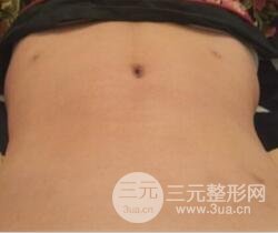 腹部抽脂價(jià)格和恢復(fù)案例