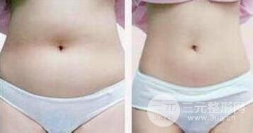 有的懶人減肥法是吸脂減肥【價格】