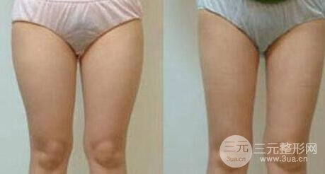 有的懶人減肥法是吸脂減肥【價格】