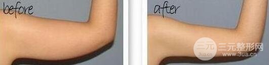 有的懶人減肥法是吸脂減肥【價格】