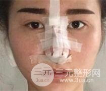 鼻子整形恢復(fù)過程真人案例