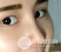 鼻子整形恢復(fù)過程真人案例