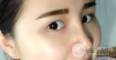 鼻子整形恢復(fù)過程真人案例