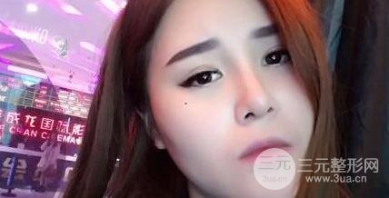 鼻子整形恢復(fù)過程真人案例