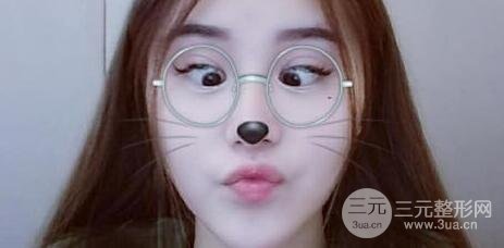 鼻子整形恢復(fù)過程真人案例