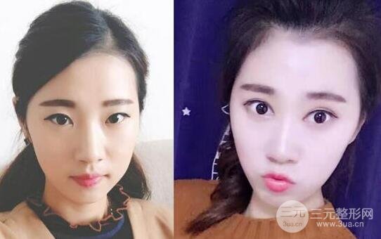 切開雙眼皮+開內(nèi)眼角案例