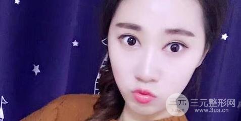 切開雙眼皮+開內(nèi)眼角案例