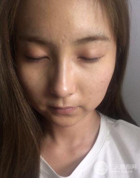 注射水光補(bǔ)水價(jià)格和案例圖片