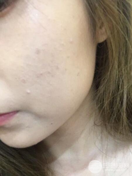 注射水光補(bǔ)水價(jià)格和案例圖片