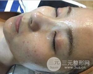 注射水光補(bǔ)水價格和案例圖片