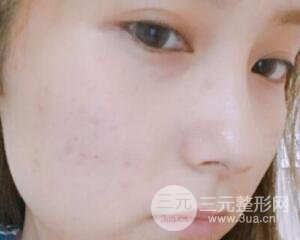 注射水光補(bǔ)水價格和案例圖片