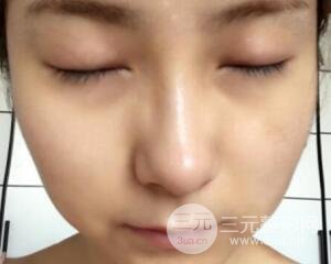 注射水光補(bǔ)水價格和案例圖片