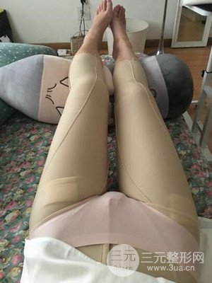 珠海萊茵門診部盧剛給我做的大腿抽脂手術(shù)，前后對比圖分享