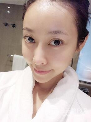 埋埋蛋白線.提升真實(shí)案例分享，珠海萊茵門診部馬中衛(wèi)醫(yī)生做的