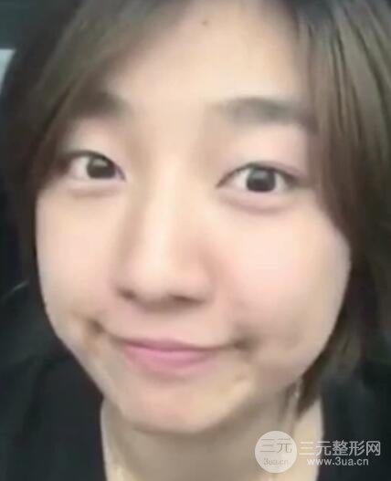 微創(chuàng)內(nèi)切去眼袋手術(shù)價格和恢復(fù)過程圖案例