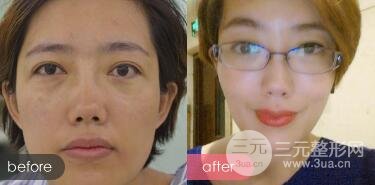 超聲法去眼袋價格和前后圖片案例