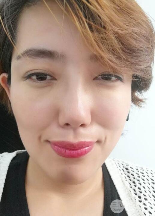 超聲法去眼袋價格和前后圖片案例