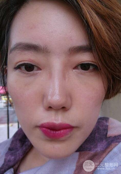 超聲法去眼袋價格和前后圖片案例