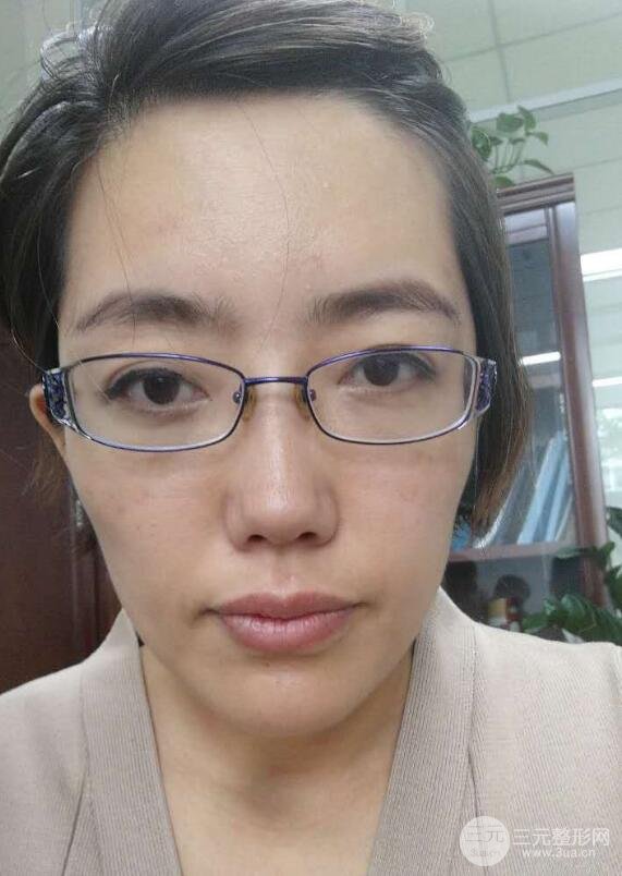 超聲法去眼袋價格和前后圖片案例