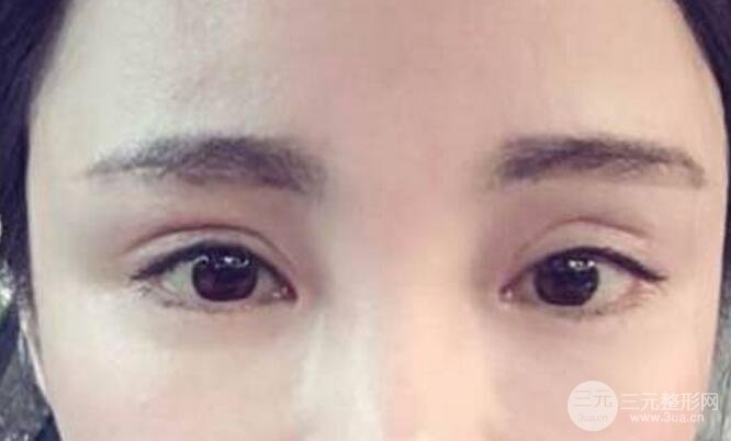 割雙眼皮失敗修復(fù)成功價(jià)格和案例圖片
