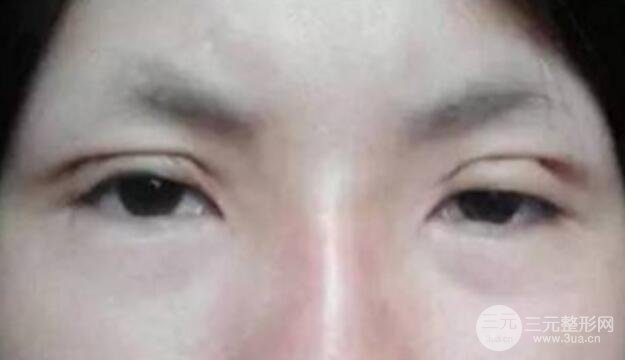 割雙眼皮失敗修復(fù)成功價(jià)格和案例圖片