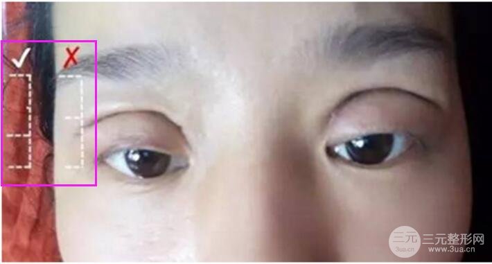 割雙眼皮失敗修復(fù)成功價(jià)格和案例圖片