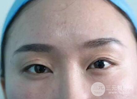 割雙眼皮失敗修復(fù)成功價(jià)格和案例圖片