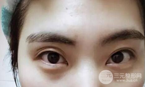 割雙眼皮失敗修復(fù)成功價(jià)格和案例圖片
