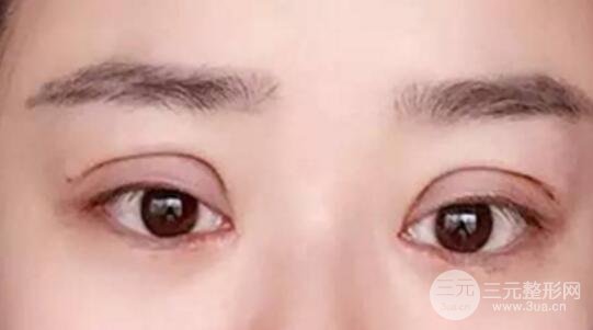 割雙眼皮失敗修復(fù)成功價(jià)格和案例圖片