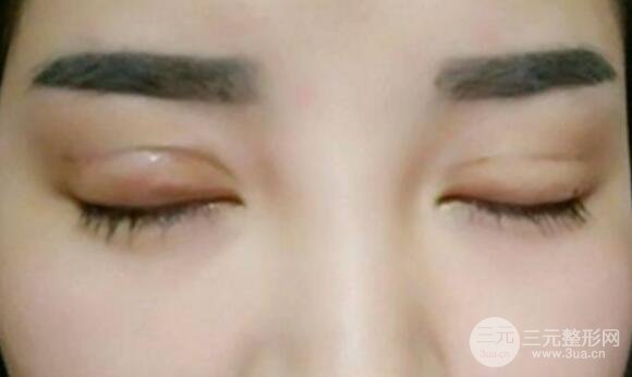 割雙眼皮失敗修復(fù)成功價(jià)格和案例圖片