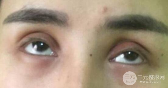 割雙眼皮失敗修復(fù)成功價(jià)格和案例圖片