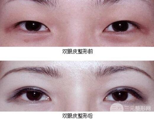 割雙眼皮失敗修復(fù)成功價(jià)格和案例圖片