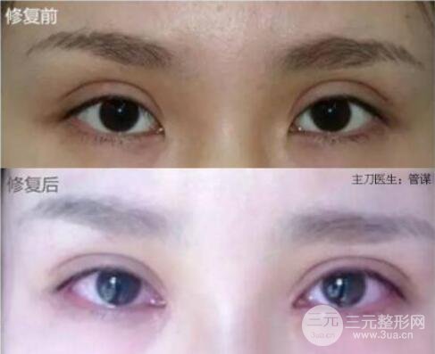 割雙眼皮失敗修復(fù)成功價(jià)格和案例圖片