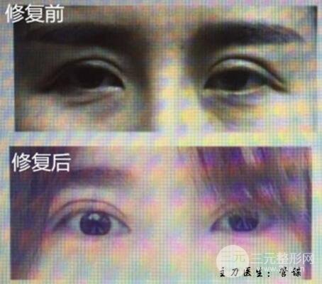 割雙眼皮失敗修復(fù)成功價(jià)格和案例圖片