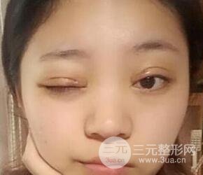 切開(kāi)雙眼皮手術(shù)恢復(fù)過(guò)程圖案例