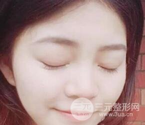 切開(kāi)雙眼皮手術(shù)恢復(fù)過(guò)程圖案例