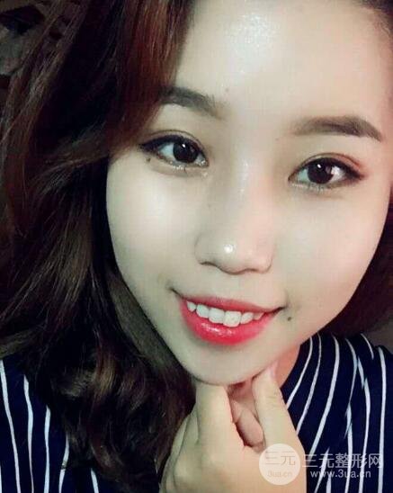 切開(kāi)雙眼皮無(wú)疤痕增生果圖案例