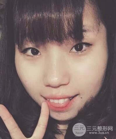 切開(kāi)雙眼皮無(wú)疤痕增生果圖案例