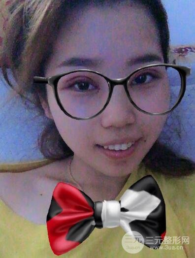 切開(kāi)雙眼皮無(wú)疤痕增生果圖案例